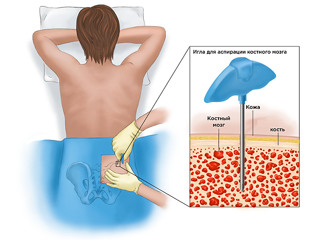 аспирационная пункция костного мозга
